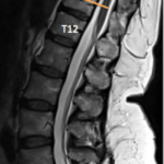 MRI image of spine.