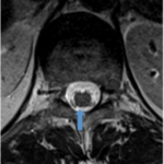 MRI image of conus and vertebrae
