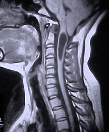 cerebrospinal fluid leak spine