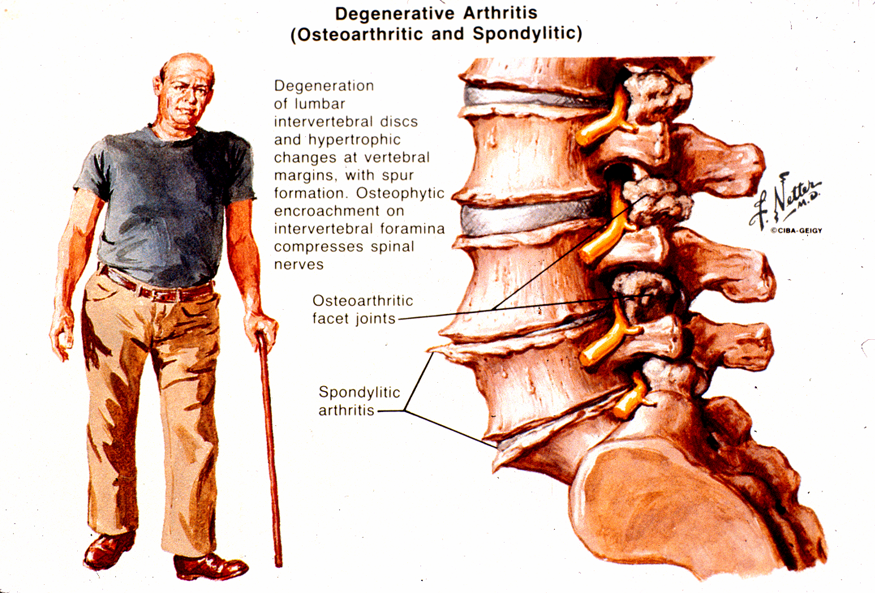 Degenerative Spinal Disorders Causing Pain Weakness And Disability
