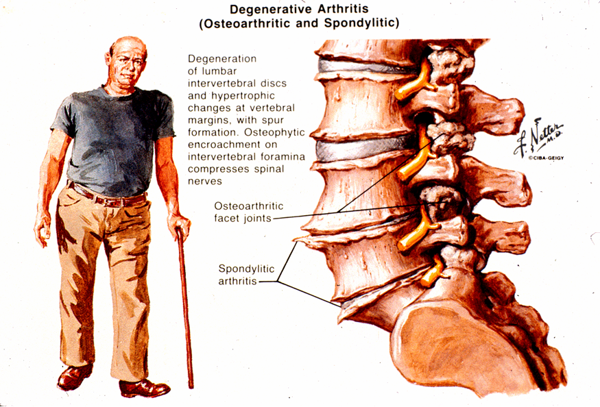 degenerative-spinal-disorders-causing-pain-weakness-and-disability