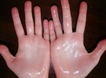 Sweating of the hands in hyperhidrosis