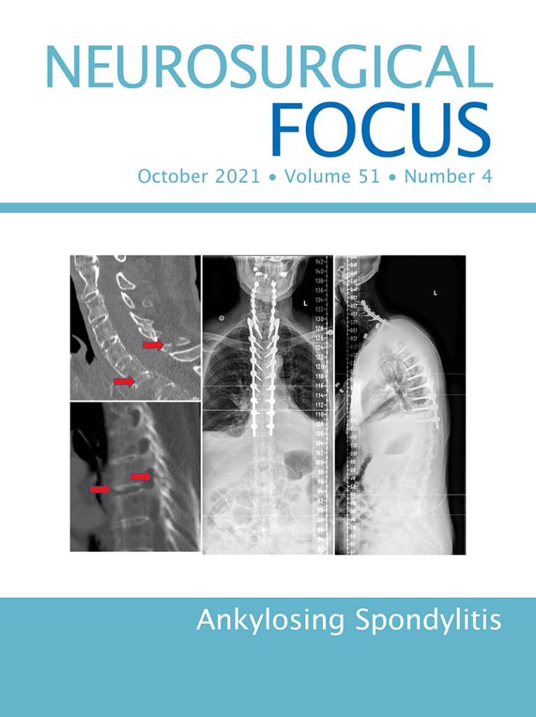 Magazine cover reading Neurosurgical Focus, October 2021, Volume 51, Number 4, Ankylosing Spondylitis 