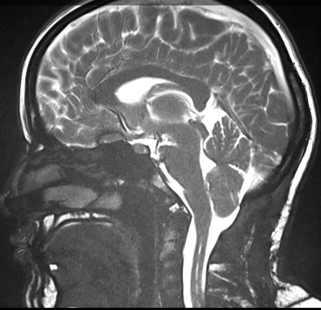 Chiari Malformation And Syringomyelia What You Should Know The Spine Practice Of Jpatrick 6621