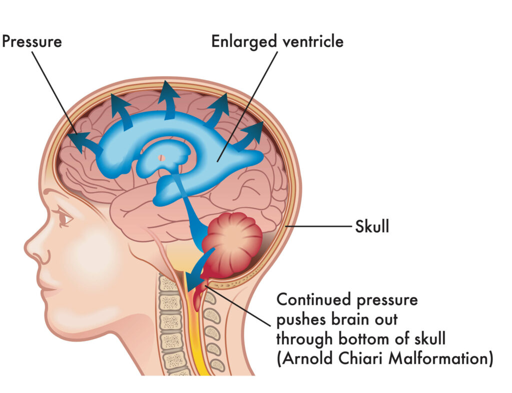 An illustration showing how enlarged ventricles increase pressure in the skull pushes the brain through the bottom of the skull.