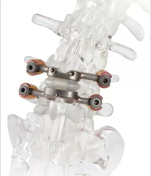 Evaluating the TOPS™ System: A New Approach to Spinal Surgery